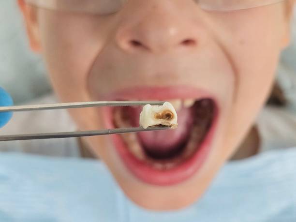Best Urgent Dental Care for Toothaches in Chilhowie, VA